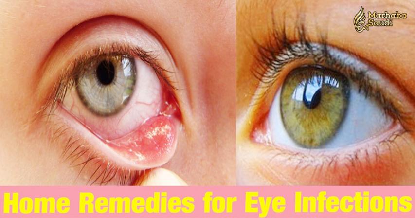 11 Home Remedies To Treat Eye Infections Naturally
