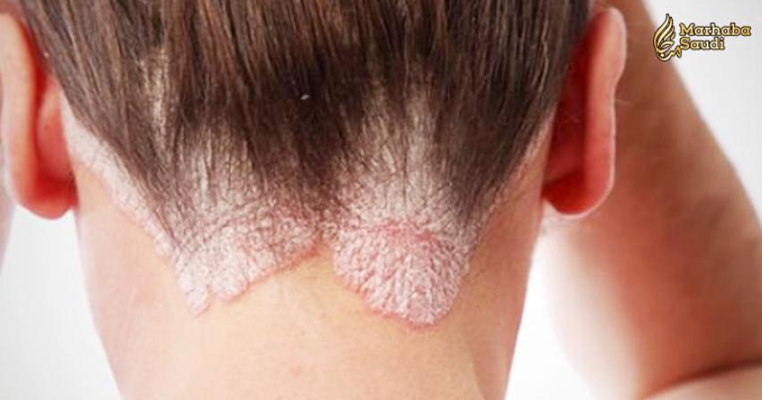 8 Proven and Natural Remedies To Treat Psoriasis
