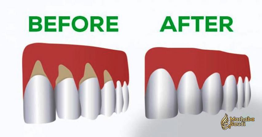 Heal Your Gums in No Time with the Help of These Natural Remedies