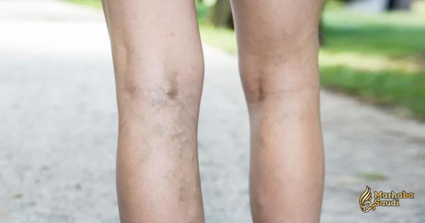 Home Remedies For Varicose Veins