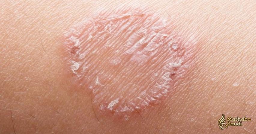 11 Effective Home Remedies For Ringworm
