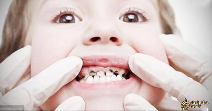 7 Ways To Prevent Tooth Decay In Toddlers
