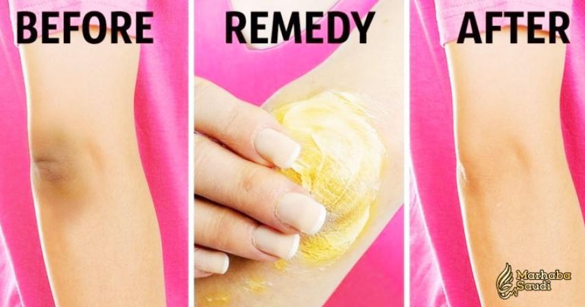 10 Simple Ways to Lighten Dark Skin on Knees and Elbows
