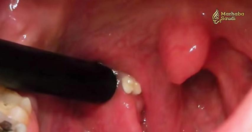 Everything You Need to Know to Remove and Prevent Tonsil Stones at Home
