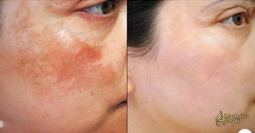 10 Natural Remedies To Reduce Melanin Production And Fix Uneven Skin