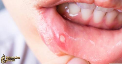 Here is what you can do to treat that mouth ulcer at home