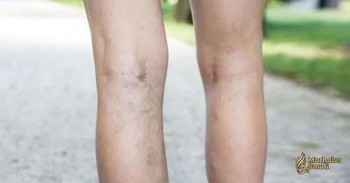 Home Remedies For Varicose Veins